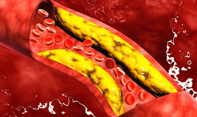 Hipercolesterolemia. Ce trebuie să știm despre managementul colesterolului? – Raportul de gardă