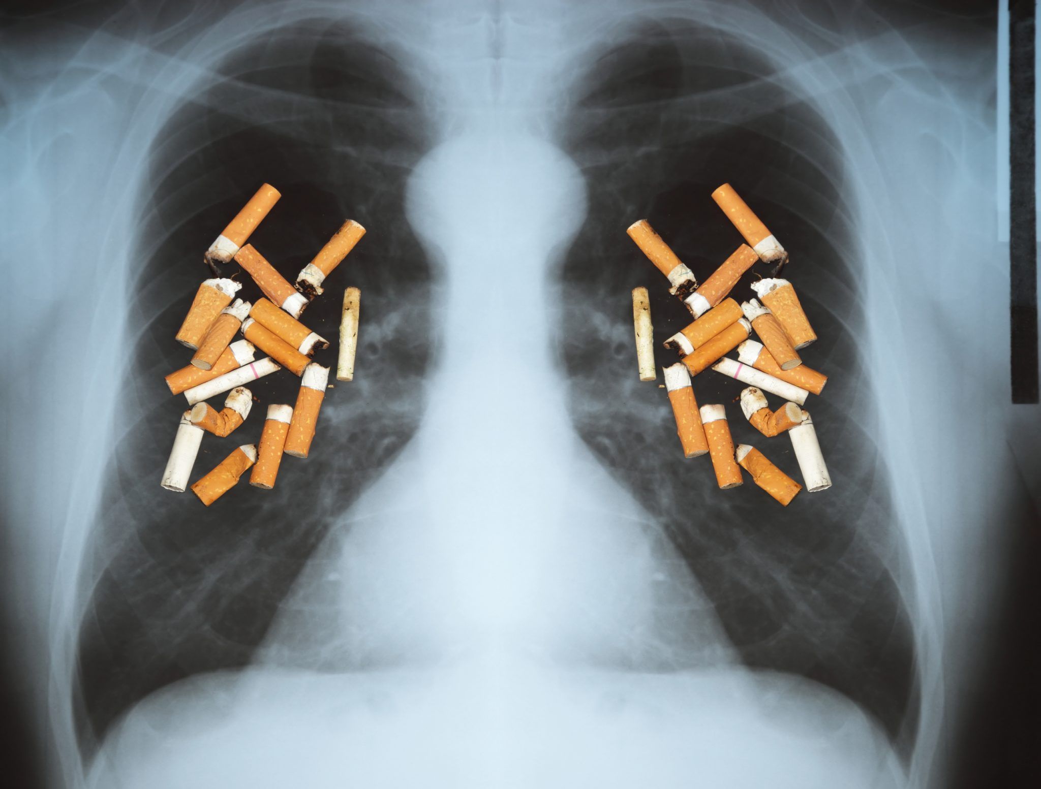 Fumatul, cauză a cancerului pulmonar