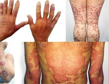 Artrita psoriazică: definiţie, cauze, simptome şi tratament - CSID: Ce se întâmplă Doctore?