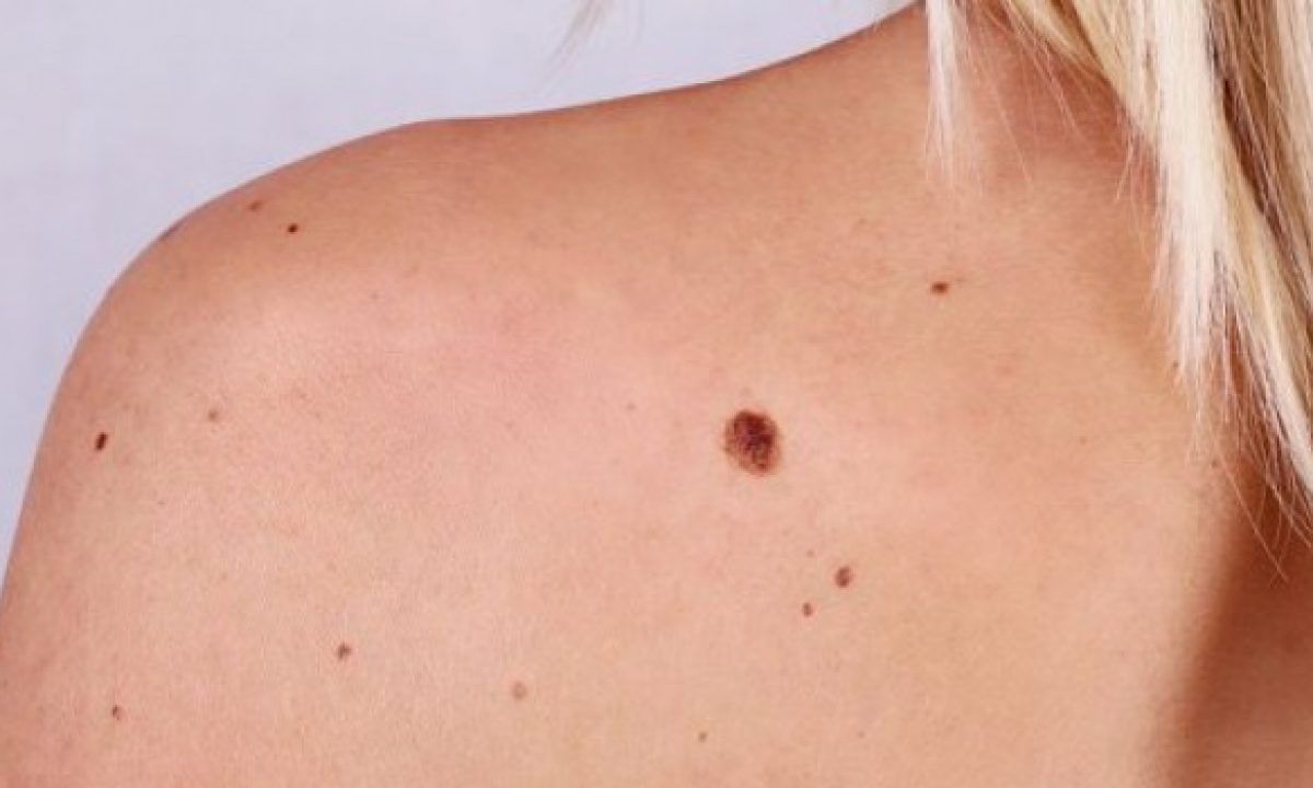 cancerul de piele este vindecabil instrucțiuni de utilizare pentru unguent papiloame