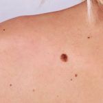 cancer-de-piele-cauze-817×350