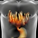 reflux gastroesofagian