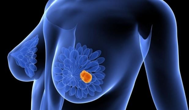 cancerul mamar oncologie)