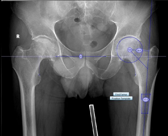 Coxartroza: cauze, simptome si metode de tratament | CENROKINETIC