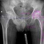 2.Pozitionarea protezei de sold prin softul dedicat
