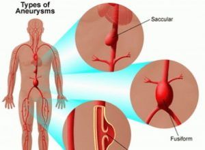 anevrism de aorta