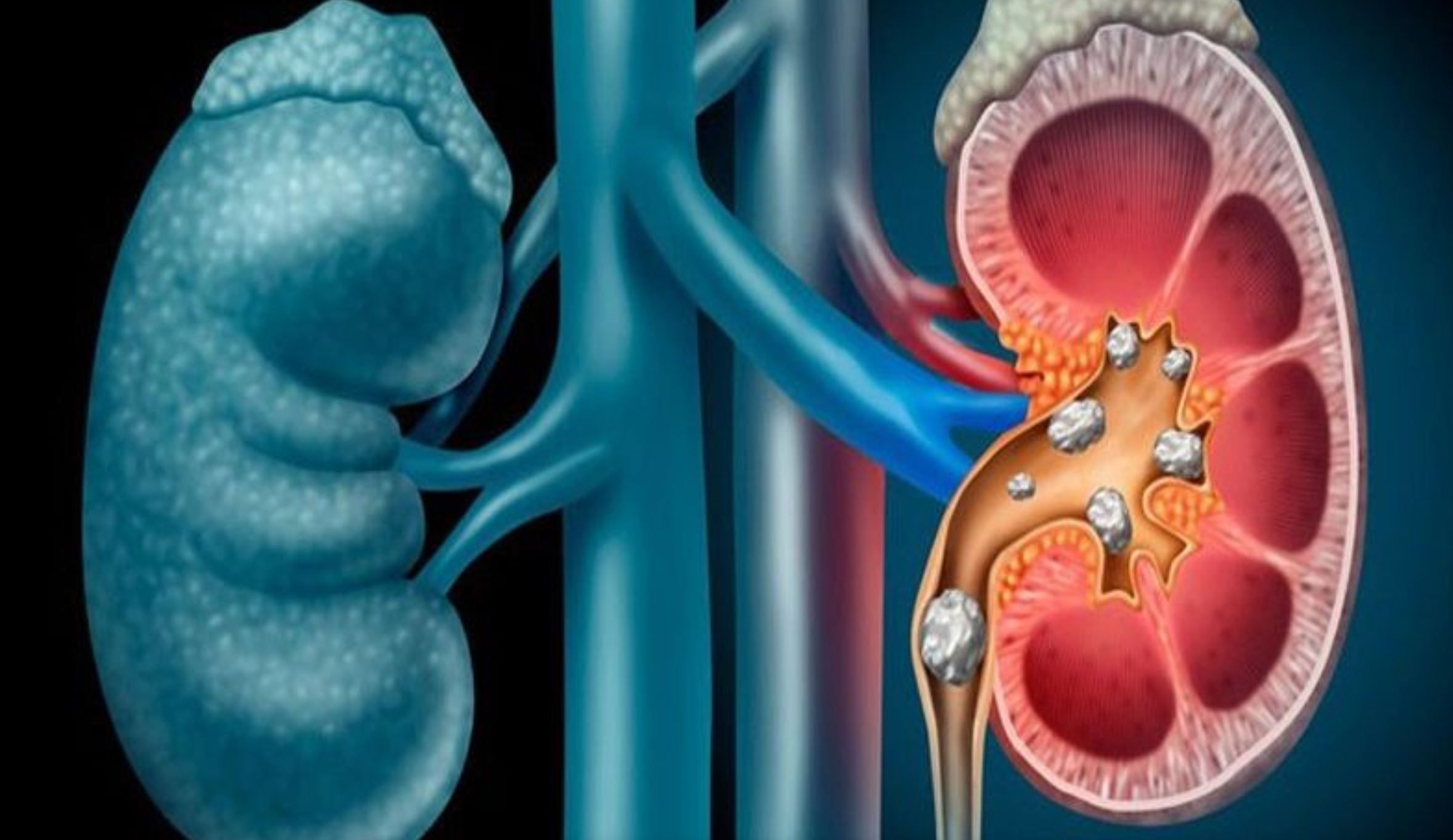 Pietre la rinichi: 6 remedii naturale