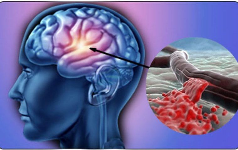 simptomele accidentului vascular cerebral