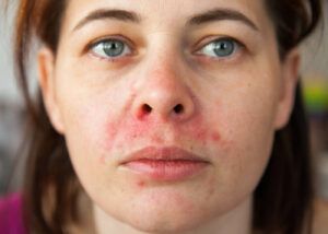Dermatita