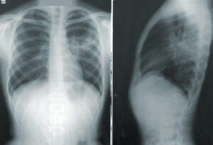 capacitatea pulmonara