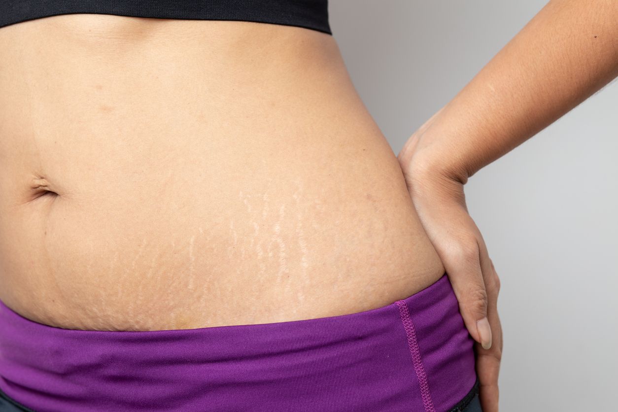 Stretch Mark Scrub