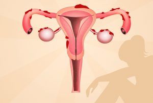 Semne că ați putea avea endometrioză.