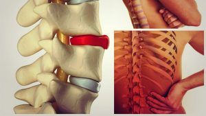 hernia de disc