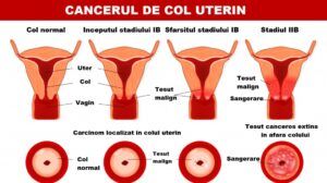 cancer uterin