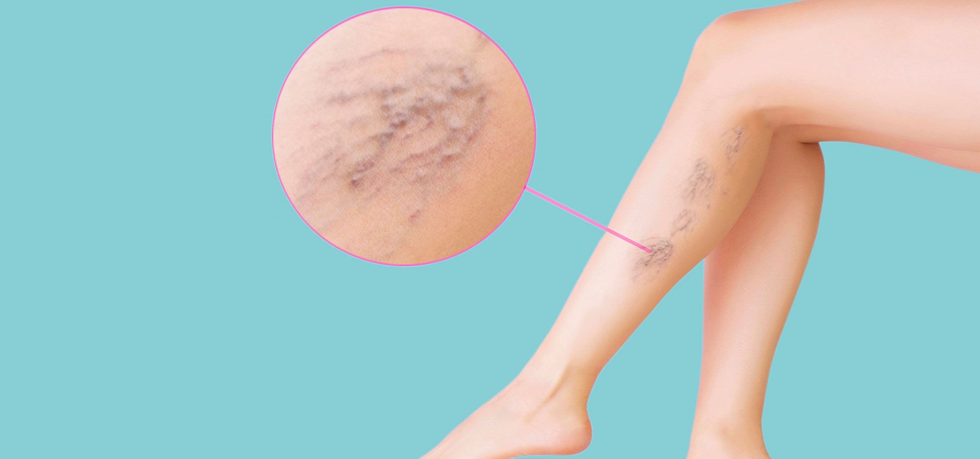 varicoza în picioarele stângi complicaii dupa tratamentul laserului varicos varicos