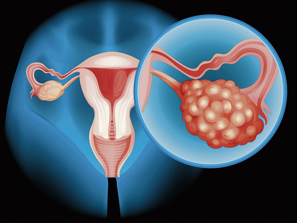 cancer ovarian