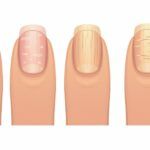 unghii cu probleme 1