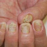 unghii psoriazis