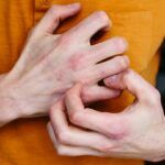 Eczema herpeticum e însoțită de mâncărime intensă