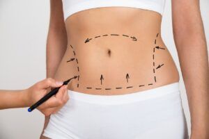 liposuctie
