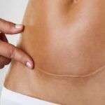 Cicatricile cheloide