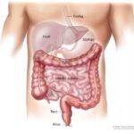 cancer colrectal