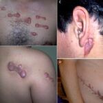 cicatricile cheloide 2