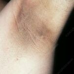 Acanthosis nigricans in the armpit