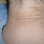 Acanthosis-Nigricans-11-700×400