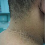 Acanthosis Nigricans