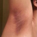Acanthosis-Nigricans-What-Causes-Dark-Armpit-Skin-natural-deodorant-myth-awake-organics-UK-beauty-brand-dark-skin-tones-image