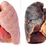 POZE CANCER PULMONAR