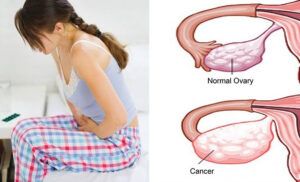 Cancer ovarian