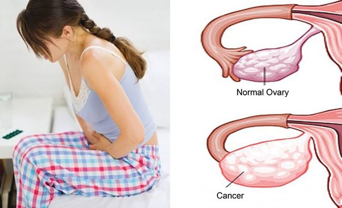 Cancerul ovarian, boala tăcută, fără simptome specifice. Cauze, prevenție, diagnostic, tratament