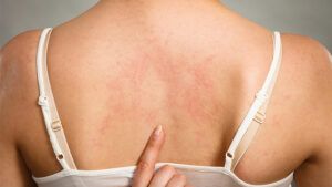 Urticaria poate apărea sub formă de plăci mici sau mari