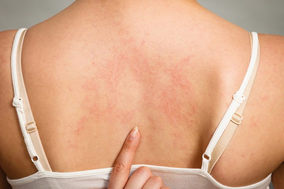 Urticaria poate apărea sub formă de plăci mici sau mari