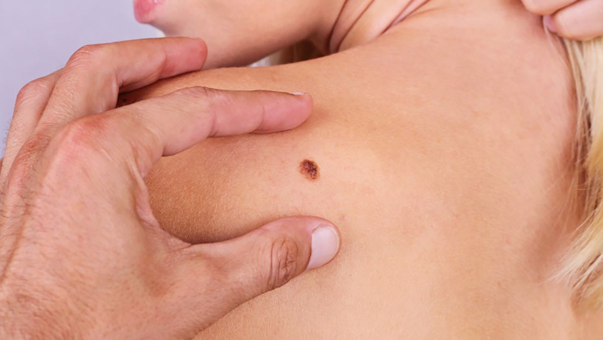 Cancerul de piele, tot mai frecvent la tineri. Semnale de alarmă