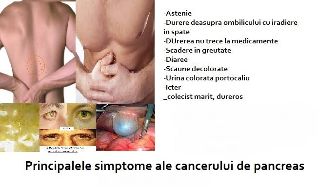 Simptome cancer pancreatic