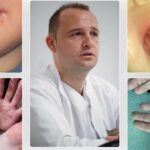 boala gura mana picior