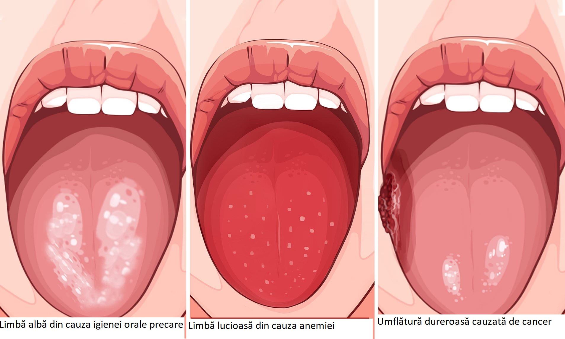 Precare  Human Papiloma Virus (HPV)