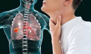 Semne ale cancerului pulmonar