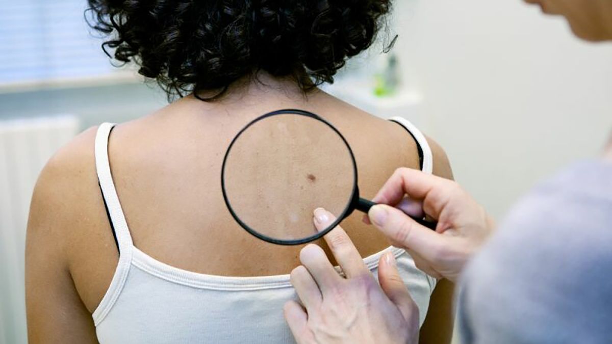 risc crescut de cancer de piele