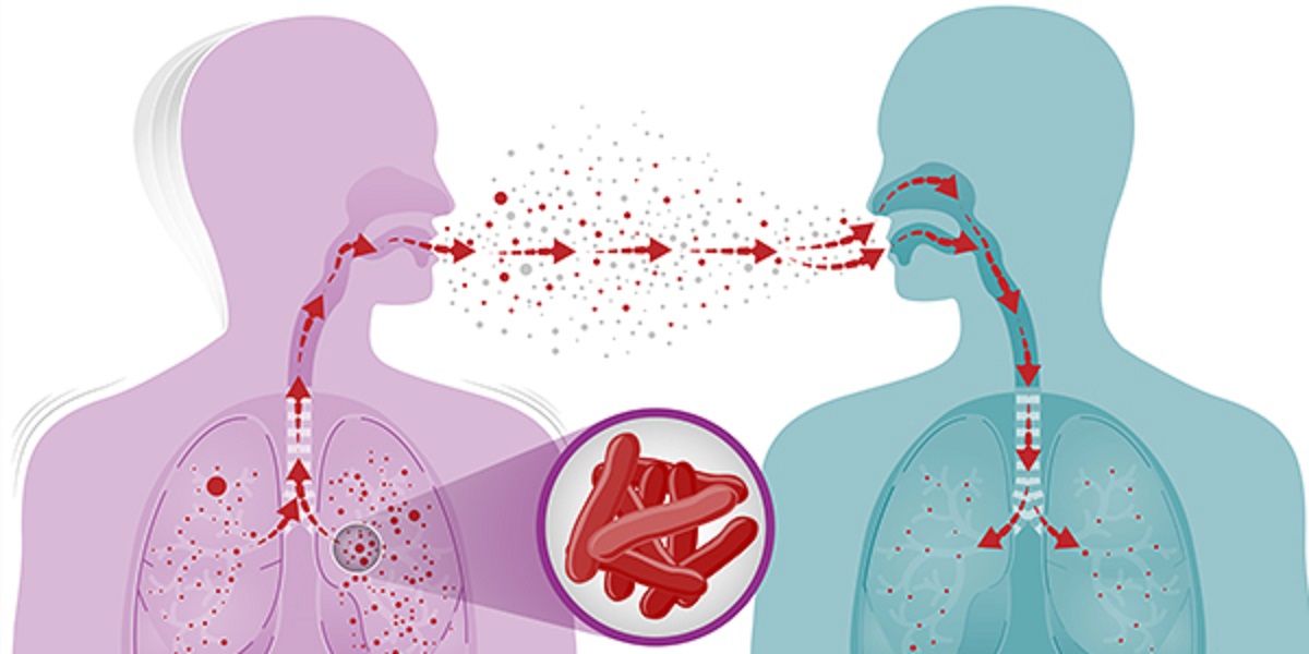 Tuberculoza este o infecție bacteriană cauzată de un virus