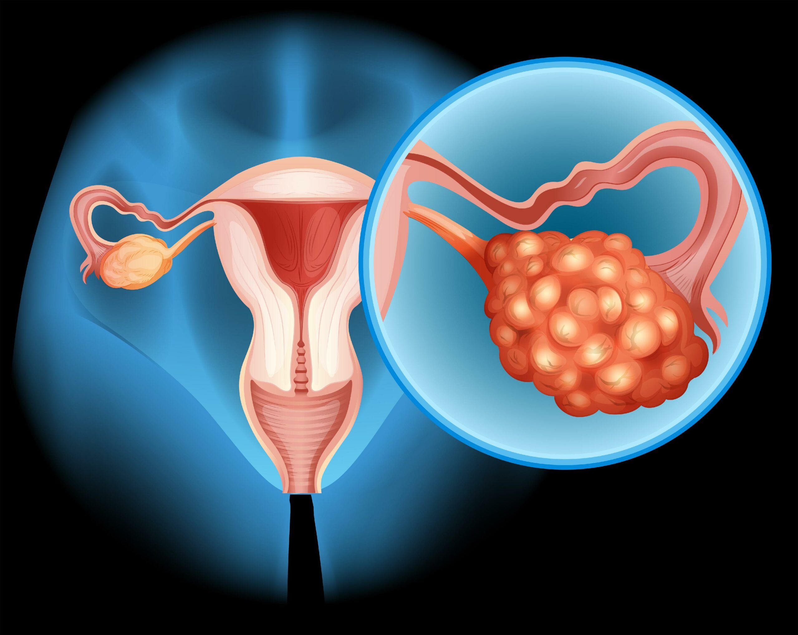 cancer ovarian