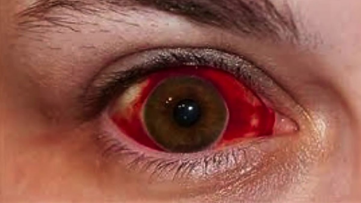 Sângerarea ochiului
