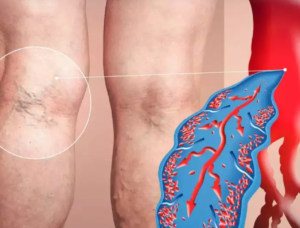 Simptome de tromboză venoasă profundă: semne de cheag de sânge care pot apărea în picioare