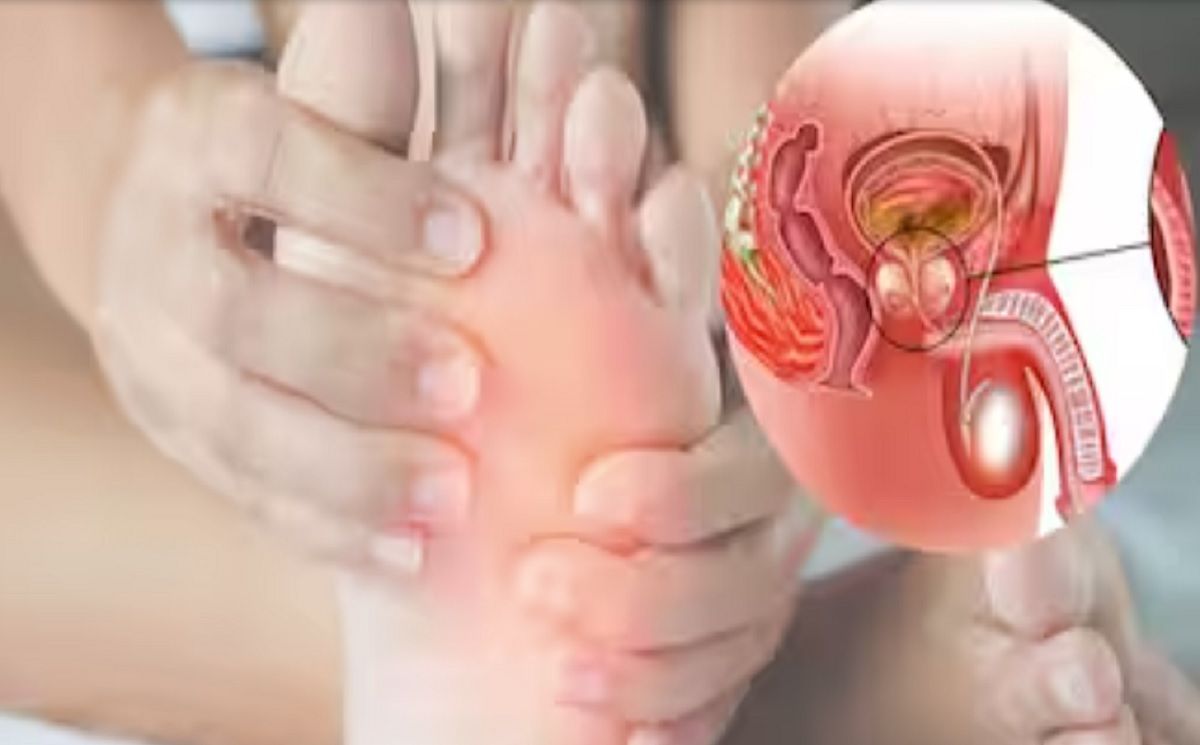 cancer prostata tumora picioare