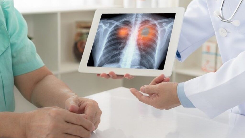radiografie cancer pulmonar
