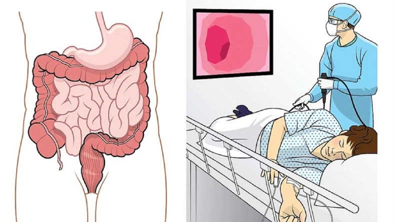EXCLUSIV. Colonoscopia clasică vs virtuală. Care sunt diferenţele? Un medic demontează miturile legate de această procedură de diagnostic