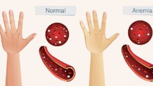 Simptome și cauze ale anemiei